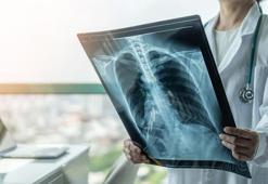 KOAH hastalığı akciğer filminde belli olur mu?