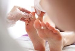 Mantar hastalığı nedir, neden olur? Mantara iyi gelen şeyler nelerdir?