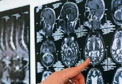 Serebral palsi; çocuklarda ilk 3 yaşa dikkat