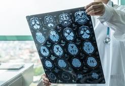 Beyin pili ağır depresyona da umut olabilir