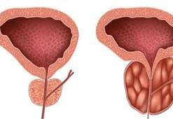 Prostat büyümesinde HOLEP tedavisi!