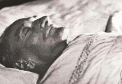 Atatürk neden öldü? Atatürk’ün hastalığı siroz nedir, siroz hastalığı neden olur, belirtileri nelerdir?