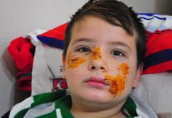 Köpek dehşeti! 8 yaşındaki Mert'in yüzüne 60 dikiş atıldı