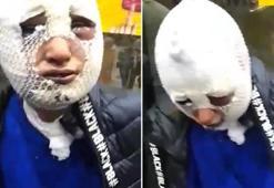 Eski sözlüsüne cinsel saldırıda bulunup başından aşağı kızgın yağ döken şüpheli tutuklandı