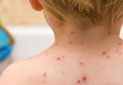 Bill Gates virüs açıklaması! Yeni virüs çiçek virüsü mü? Çiçek virüsü nedir, aşısı var mı?