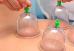 Şubat ayı hacamat günleri 2022! Hacamat günleri ne zaman, hacamat öncesi yapılması gerekenler?