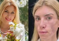 Rus güzellik kraliçesi Yulia Tarasevich’in hayatı kabus oldu! Estetik faciası...