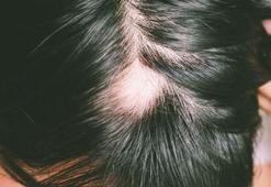 Alopesi nedir? Will Smith’in karısı Jada Pinkett Smith hastalığı Alopecia neden olur, Alopecia Areata nasıl anlaşılır, tedavisi var mı?