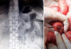 Doktorlar bile inanamadı! Karın ağrısı şikayetiyle gitti hayatının şokunu yaşadı