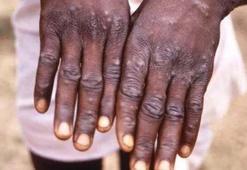 Maymun çiçeği virüsü nedir, ilk vaka Türkiye’de görüldü mü? Maymun Çiçeği hastalığı belirtileri nelerdir, nasıl bulaşır, tedavisi var mı, öldürür mü?