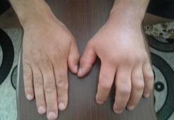 Türkiye’de bu hastalık tanınmıyor! Alerji mi, Herediter Anjiyoödem mi?