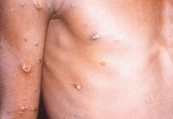 Maymun çiçeği virüsü nedir, belirtileri ne? Maymun çiçeği virüsü bulaşıcı mı?