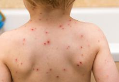 Su çiçeği aşısı ne zaman yapılır? İşte suçiçeği aşı takvimi!