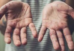 Maymun çiçeği virüsü nasıl bulaşır, belirtileri nelerdir, Türkiye’de var mı, öldürür mü? İşte Maymun çiçeği hastalığı hakkında merak edilenler...