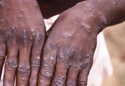 Yeni salgın çocukları vuruyor! Maymun çiçeği...