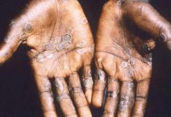 Maymun çiçeği virüsü için karantina gelir mi? Maymun çiçeği virüsü hamile ve çocukları etkiliyor mu?