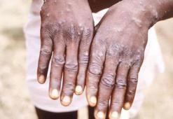 DSÖ'den maymun çiçeği mesajı: Toplu aşılamaya gerek yok