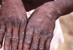 Maymun çiçeği virüsünde aşılar etkili mi?