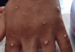 'Maymun çiçeği ' alarmı! Hemen polis ve sağlık ekiplerine haber verdiler...