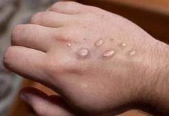 Maymun çiçeği Türkiye’de var mı, Maymun çiçeği hastalığı İstanbul’da görüldü mü?