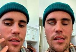 Justin Bieber'ın hastalığı ne? Ramsay Hunt sendromu nedir, belirtileri ne?