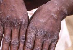 Maymun çiçeği virüsü kapıya dayandı! Şimdi de komşuya sıçradı