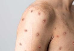 Maymun çiçeği hastalığı Türkiye'de var mı? Hastalık nasıl bulaşıyor, maymun çiçeği virüsü öldürür mü, nasıl geçer ve bulaşır, belirtileri nelerdir?