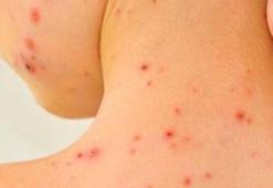 Su çiçeği aşısı maymun çiçeğinden korur mu? Maymun çiçeği aşısı var mı?