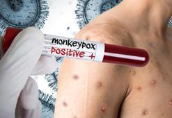 Maymun çiçeği virüsü hakkında tüm merak edilenler! Türkiye’de ilk vaka tespit edildi, salgın endişesi başladı...