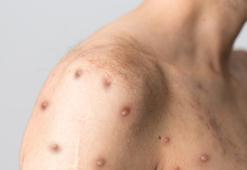 'Maymun çiçeği virüsü, pandemi boyutuna ulaşmayacak