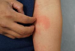 Yaz alerjisine dikkat! Bunları yedikten sonra kızarıklık, kaşıntı ya da ödem oluyorsa...