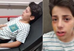 'Ses bombası yapımı' videosu izleyip evde denedi, karışım patladı! Çocuk gözlerinden yaralandı