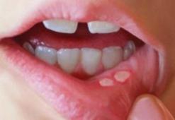 Ağız yarası korona belirtisi mi, korona belirtileri arasında ağız yarası var mı? Yeni belirtiler ortaya çıktı!