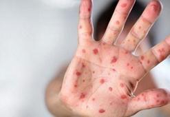 Çiçek aşısı, maymun çiçeğine karşı yüzde 85 koruyor