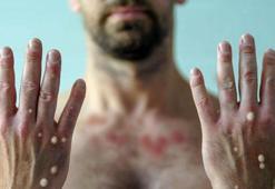 Maymun çiçeği virüsü 92 ülkede görüldü: Dünya genelindeki vaka sayısı 35 bini aştı