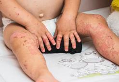 Koronavirüs ve maymun çiçeği derken yeni salgın patladı! Çok hızlı yayılıyor, çocuklar için büyük tehdit