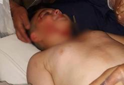 Sahipsiz köpeğin saldırdığı çocuğa 40 dikiş atıldı