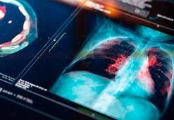 Yeni virüs yayılıyor! Gizemli zatürre vakaları arttı! Yeni ölümcül virüsün adı ne?