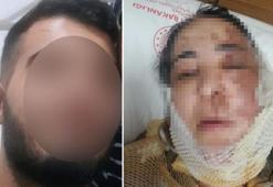 Üvey evlat dehşeti! Evlenmesin diye yüzüne kezzap döktü