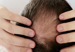 Saç dökülmesini tarihe karıştıran yöntemi açıkladı: 'Çözüm 3-4 adet saç kökünde'