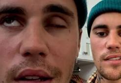 Justin Bieber, Ramsay Hunt sendromuna yakalanmıştı! Turnesini iptal etti
