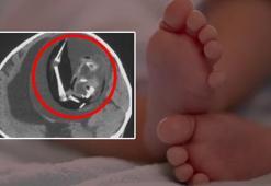 Beyninden ikiz kardeşini çıkardılar! Doktorlar şokta, 1 yaşında tarihe geçti
