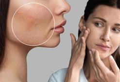 Sağlıksız cilt görünümüne neden oluyor! Bu yöntemlerle gözeneklerinizden kurtulabilirsiniz