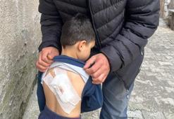 Sokak köpeklerinin saldırdığı 4 yaşındaki çocuk ölümden döndü