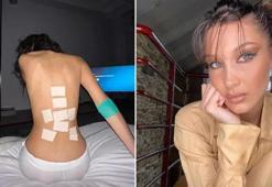 Bella Hadid'in amansız hastalığı: Lyme