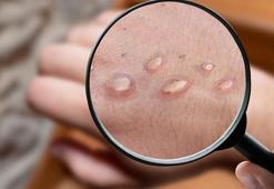 Maymun çiçeği virüsü nedeniyle 2 kişi karantinaya alındı