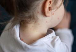 Kızamık salgını 2 ilde yükselişte