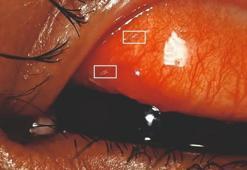 Kızarıklık şikayetiyle hastaneye gitti! Gözünden sinek larvaları çıktı