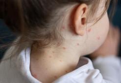 Kızamık uyarısı: Okullar açılmadan aşıları tamamlayın