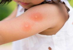 5 dakikada böcek ısırığını geçiriyor! Ağrıyı ve kaşıntıyI anında durduran 7 bitkisel yöntem var!